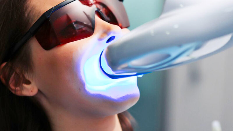 Отбеливание зубов в Ташкенте: лучшие способы для идеальной улыбки